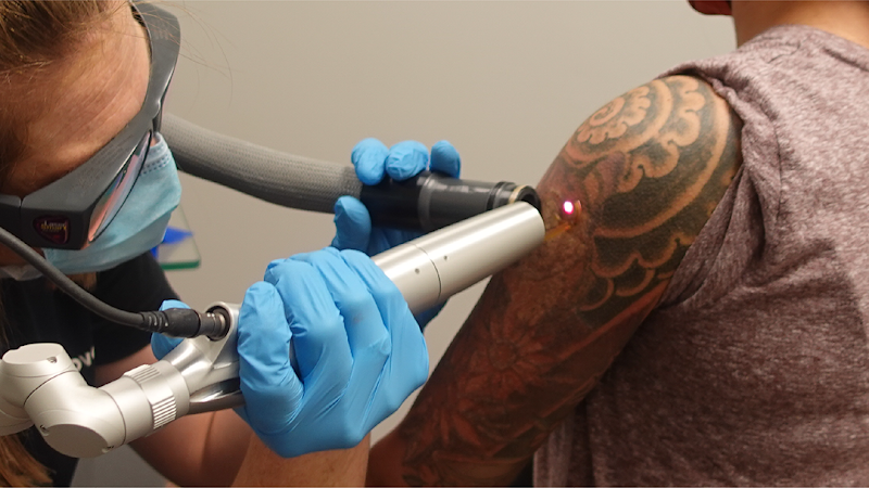 Work by Removery Tattoo Removal & Fading