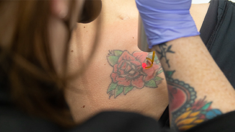 Work by Removery Tattoo Removal & Fading