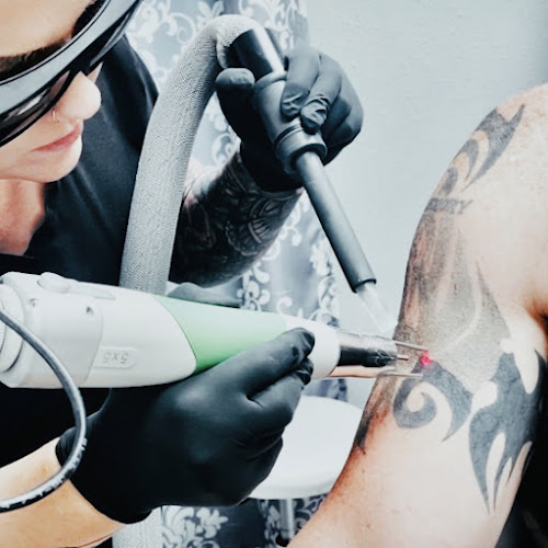 Work by Denton Laser Tattoo Removal
