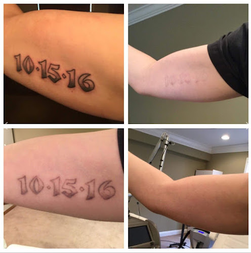 Work by Lexington Tattoo Removal