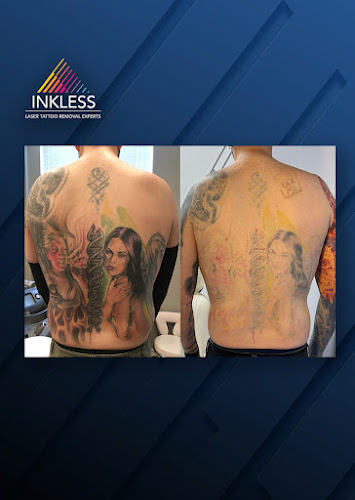 Work by Inkless Tattoo Removal