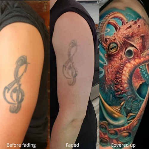 Work by Removery Tattoo Removal & Fading