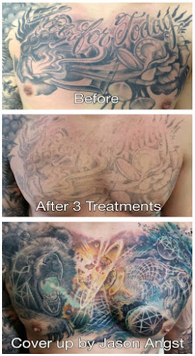 Work by Removery Tattoo Removal & Fading