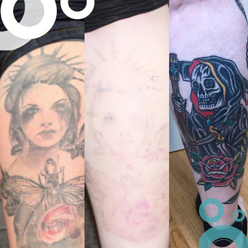 Work by Removery Tattoo Removal & Fading