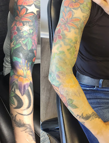 Work by Rochester Tattoo Removal